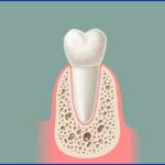 U kojim situacijama ugraditi zubne implantate 2